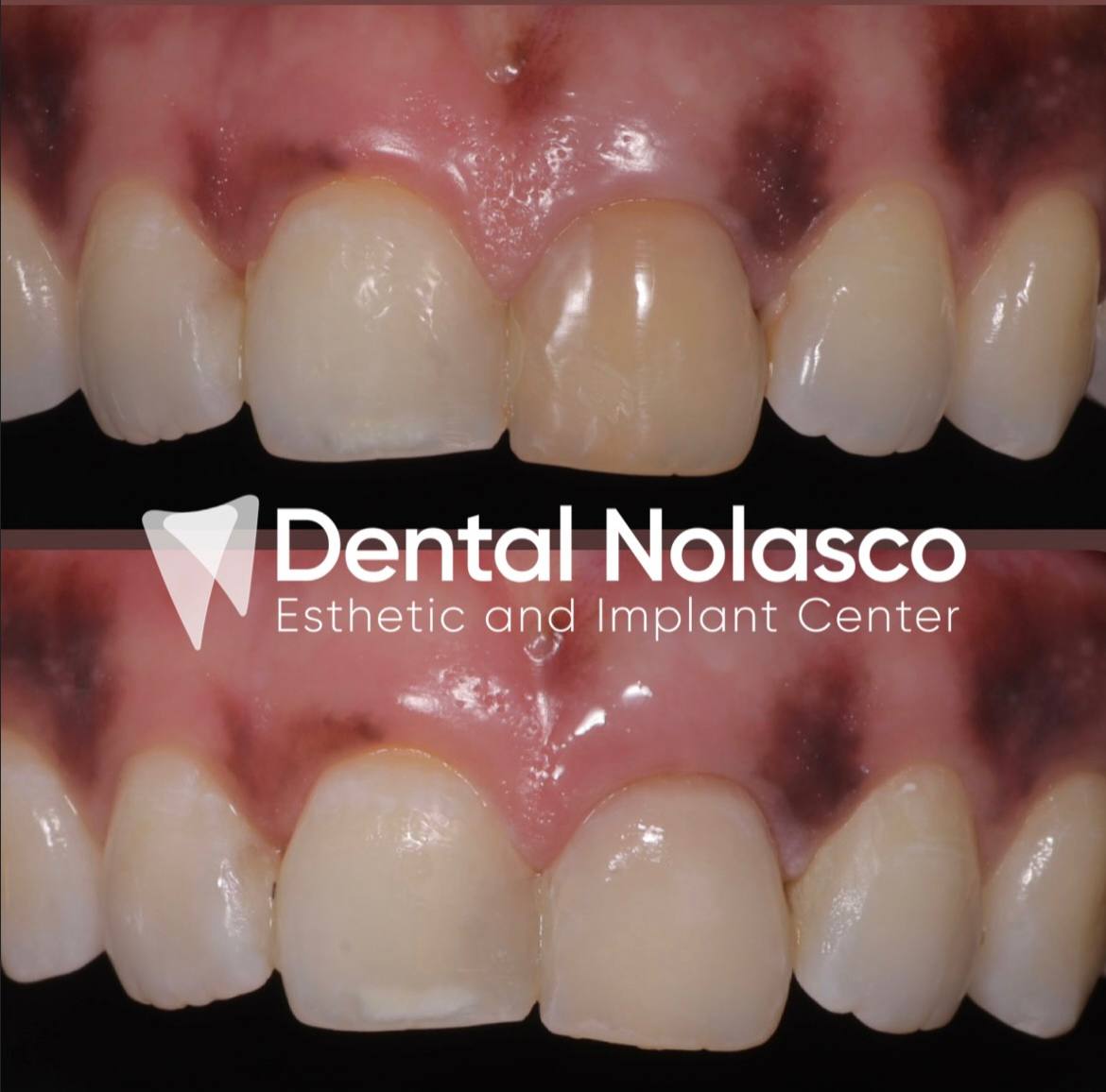 Antes y Después - Caso 4